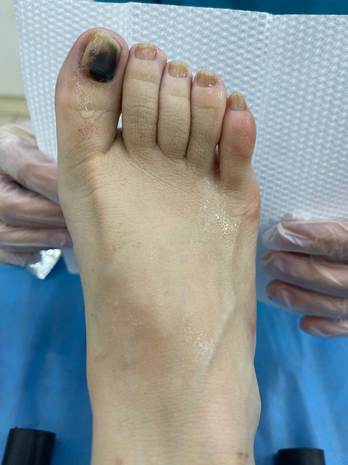 脚趾甲碰到里面流血有没有关系
