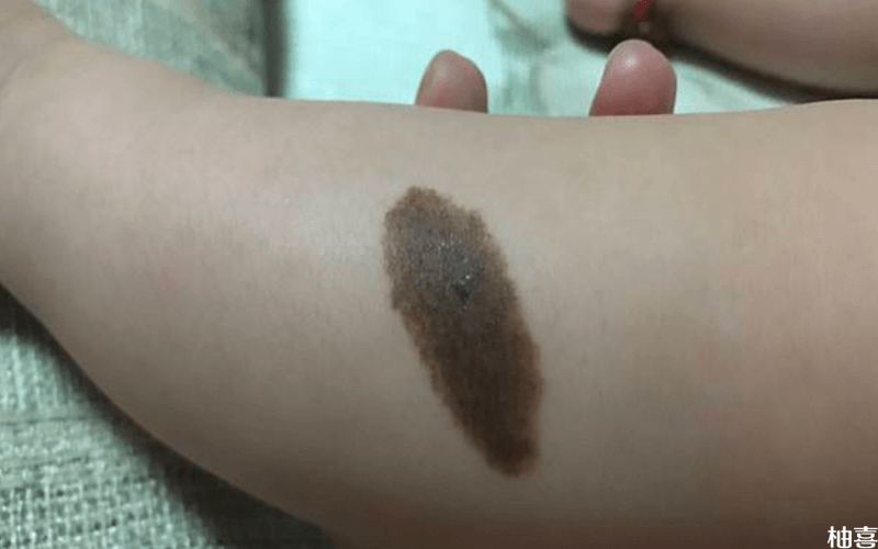 有谁知道一些胎记的相关传说?比如蝴蝶胎记。