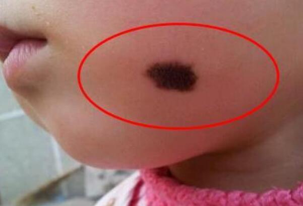 有谁知道一些胎记的相关传说?比如蝴蝶胎记。