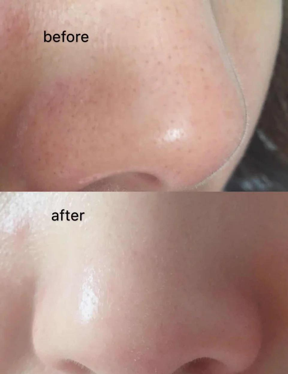 鼻子黑头怎么去除简单方法