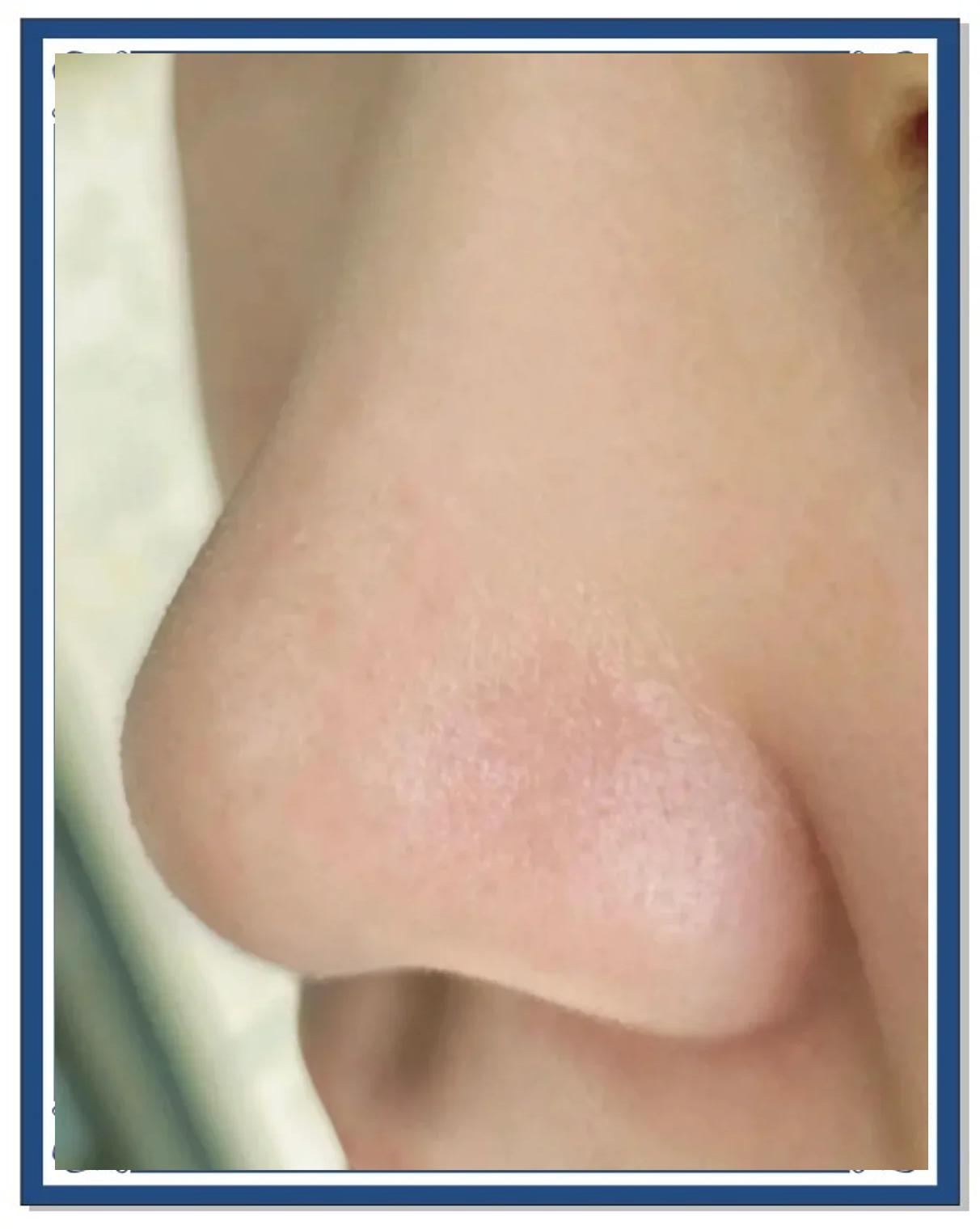 鼻子黑头怎么去除简单方法