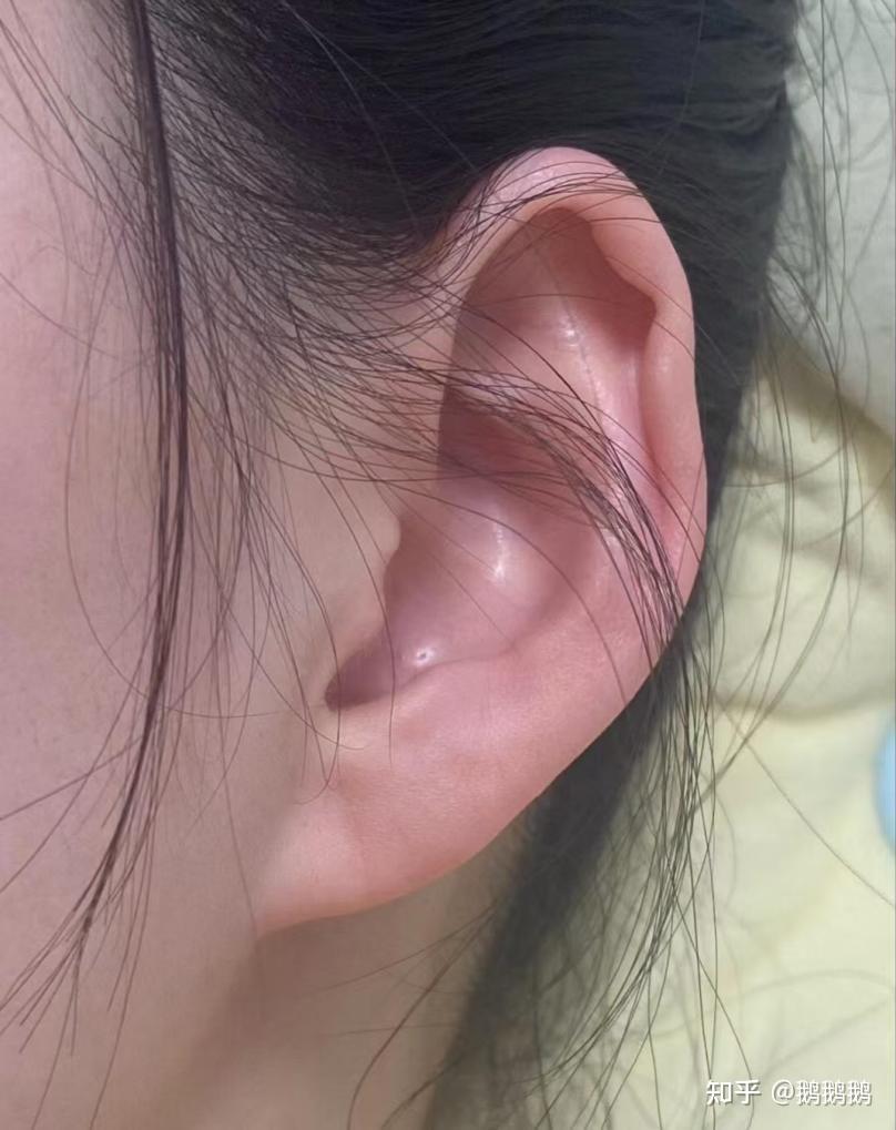 左耳耳屎是湿的,还有点臭怎么怎么回事