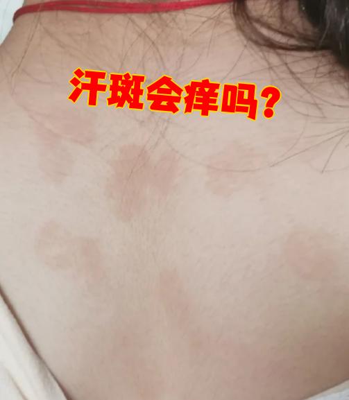 治疗汗斑小偏方汗斑的症状