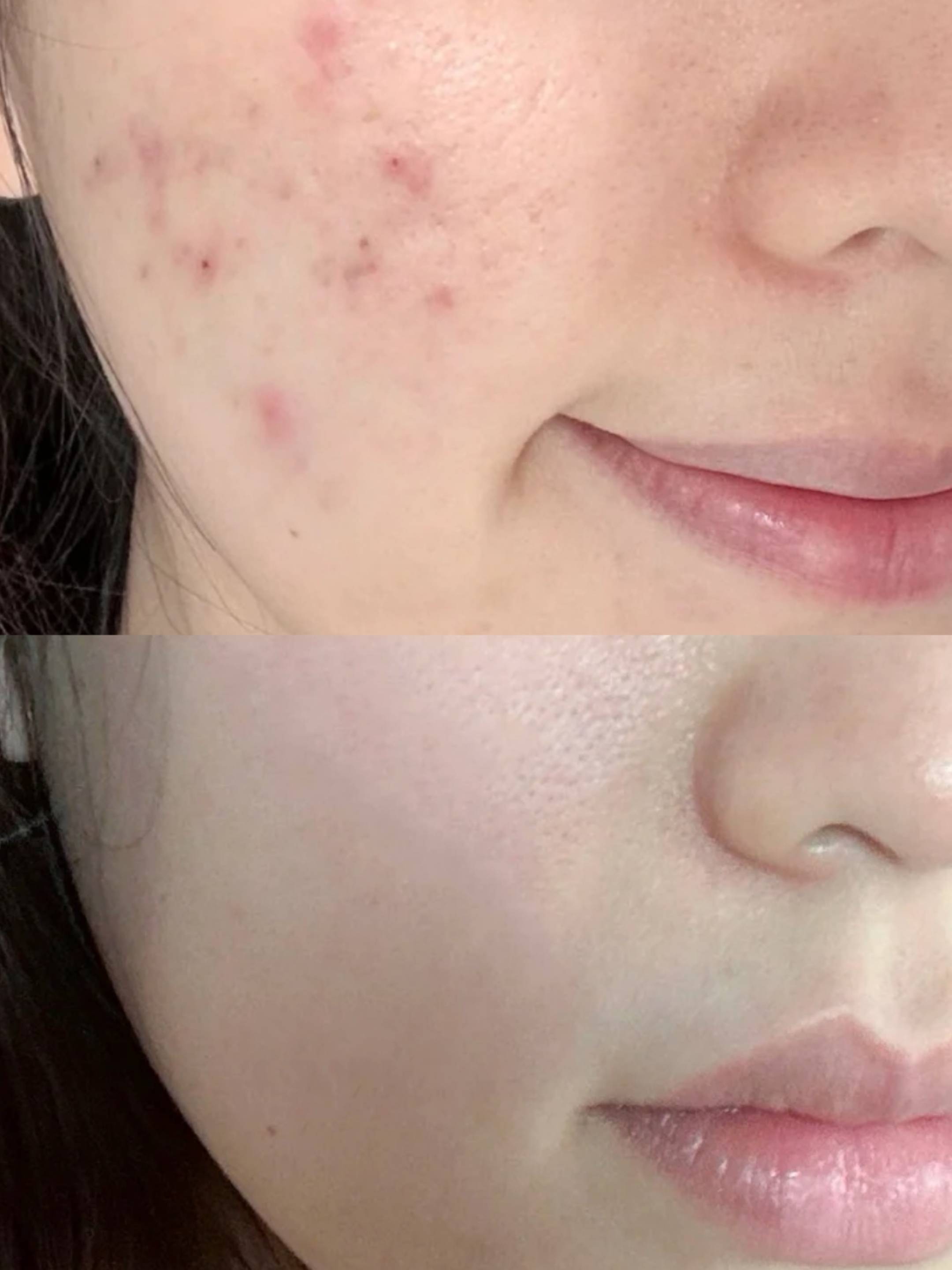 ps怎样去除脸上的痘痘