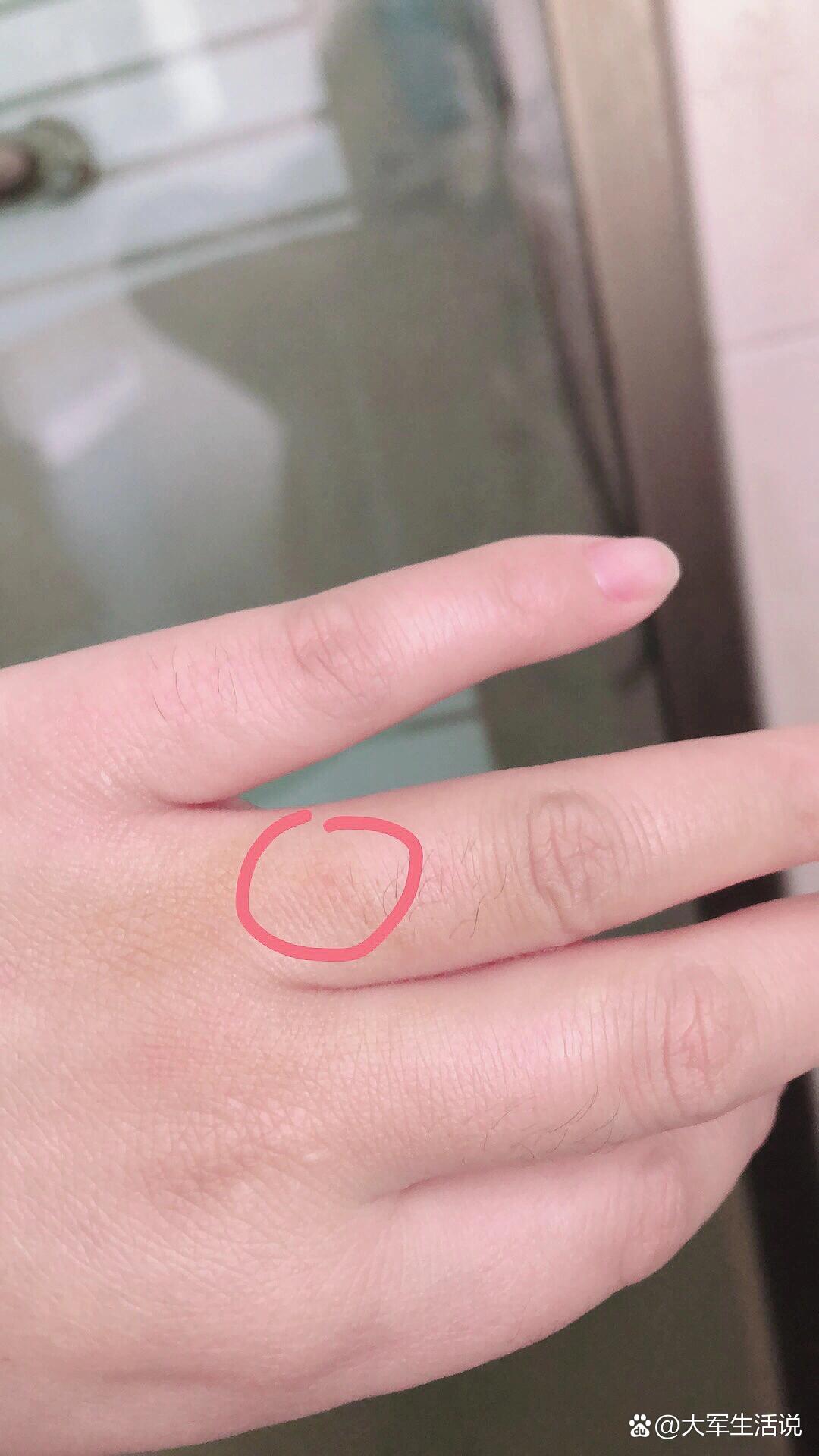 被猫抓伤破皮没出血怎么办