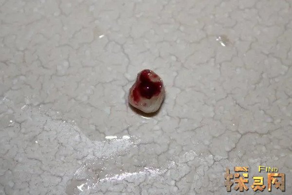 梦见自己牙齿掉了好多