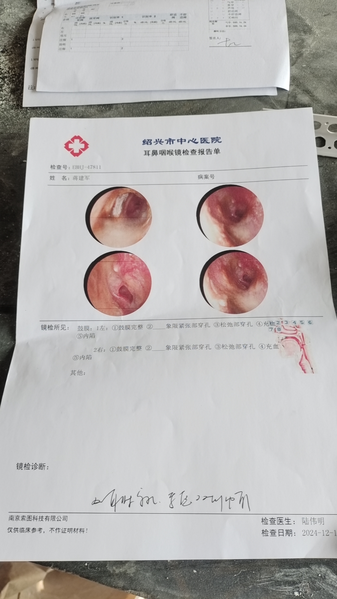 耳膜穿孔的赔偿费用是多少？