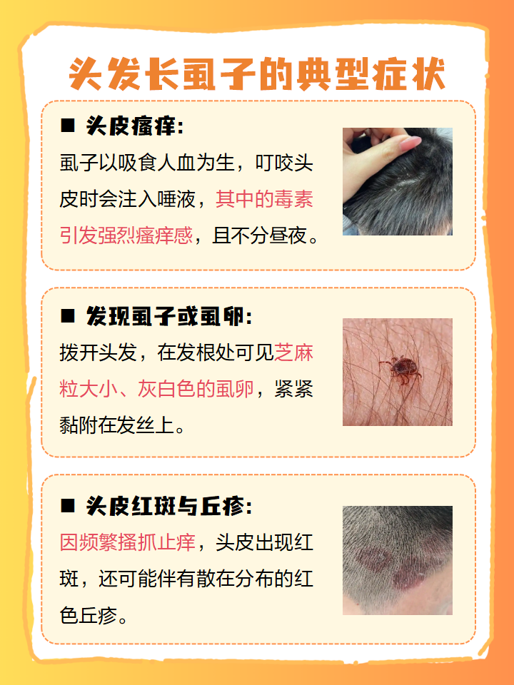 怎么知道自己有没有虱子?