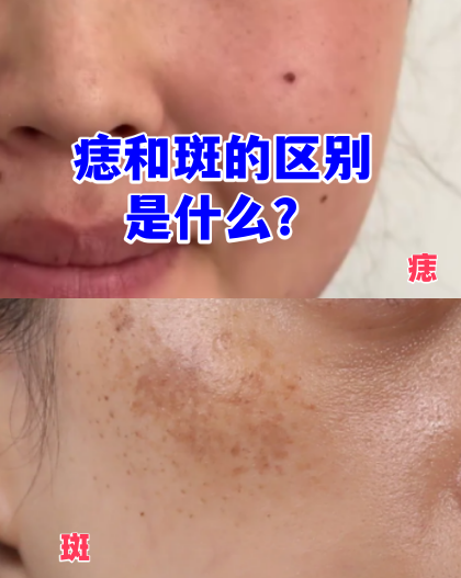请问长斑和痣是什么体质