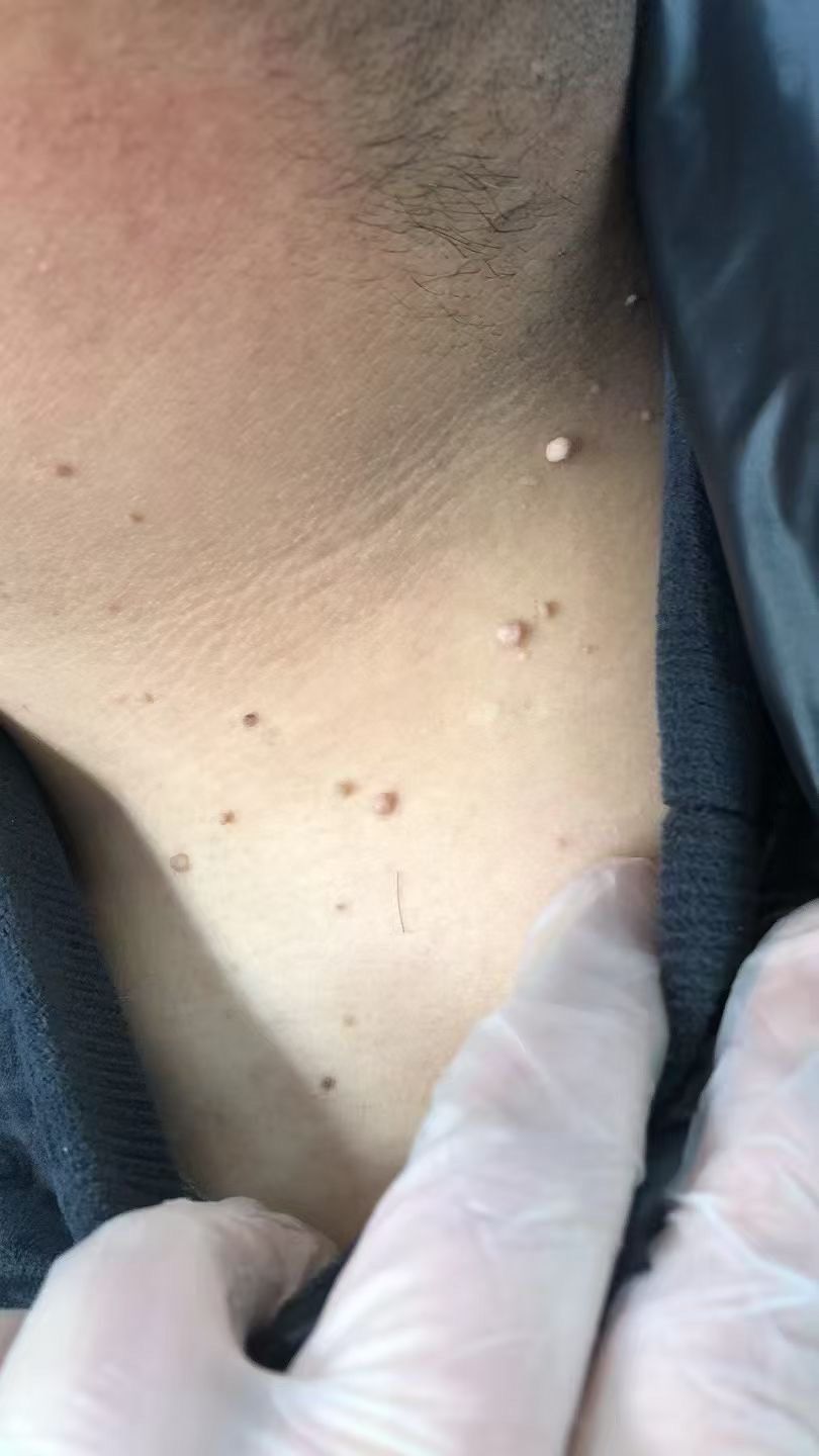 脖子上的丝状疣怎么去除