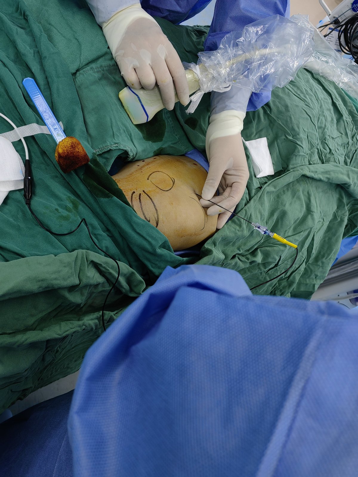 射频消融手术是怎样的手术