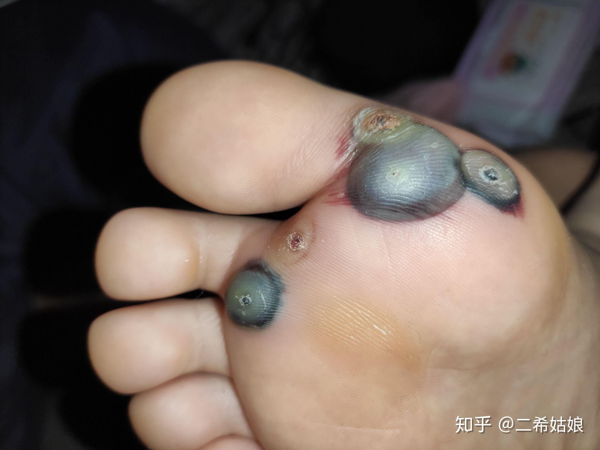 液氮治瘊子价格是多少,能单独购买医用液氮么