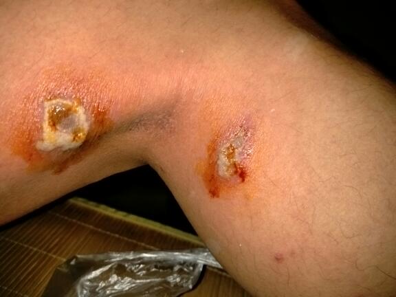 蟑螂咬了什么症状图片-百度