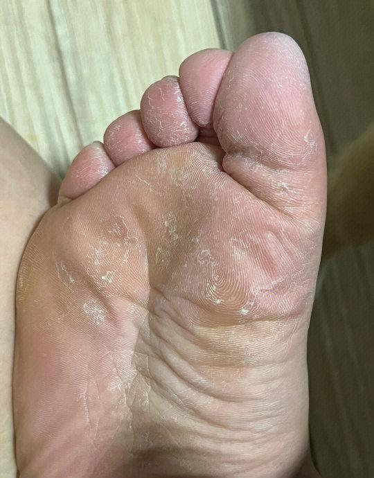 脚底出汗主要是什么原因