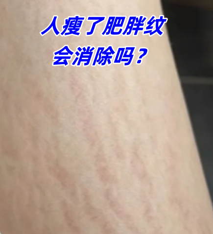 肥胖纹是胖了还是瘦了肥胖纹一般长在哪里