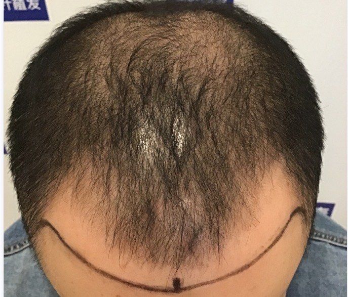 梦到自己秃顶了是什么征兆