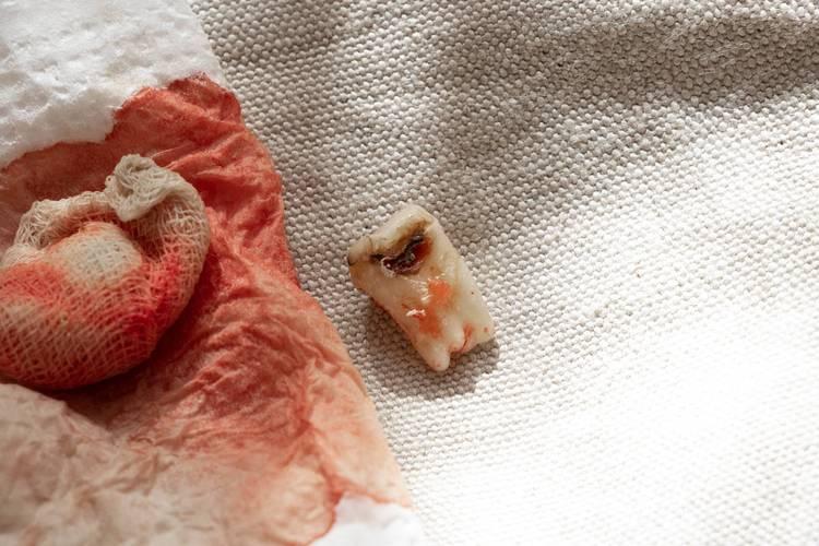 梦见自己把松动牙拔掉