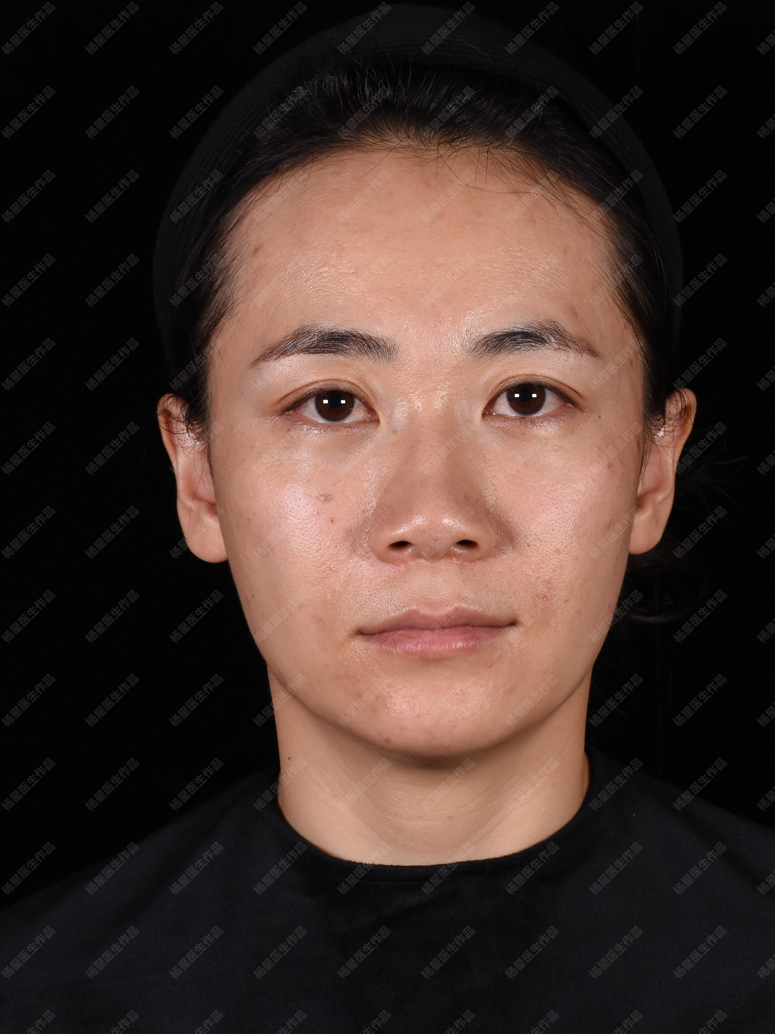 苹果肌在哪个位置苹果肌塌陷怎么办