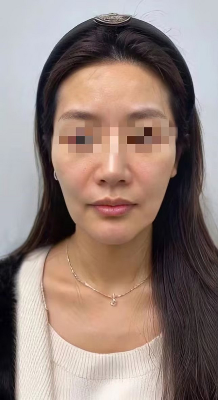 苹果肌在哪个位置苹果肌塌陷怎么办