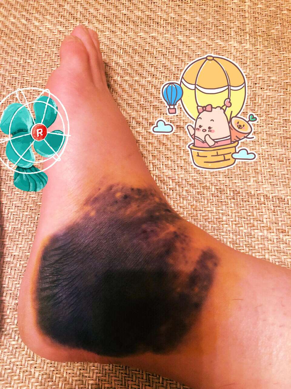 用热鸡蛋敷淤青的正确做法