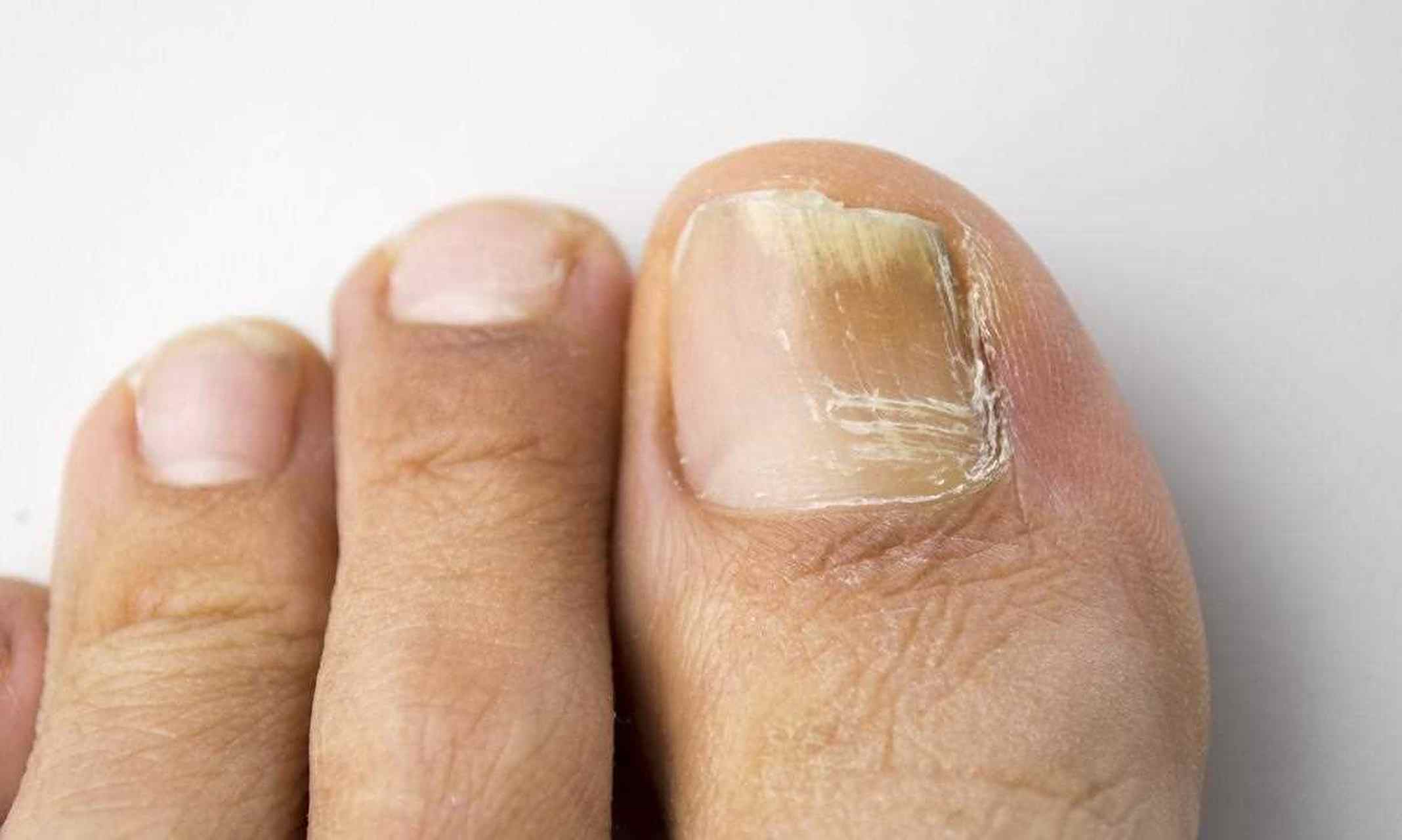 灰指甲前期的症状有哪些