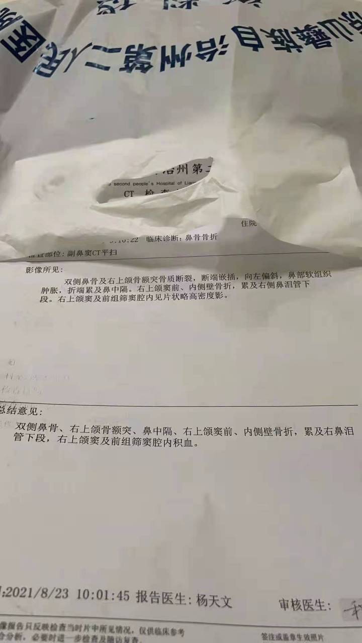 鼻子骨折赔偿标准5万?