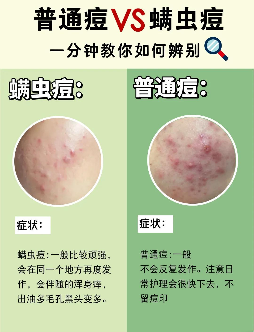 怎么判断脸上是痘痘还是螨虫