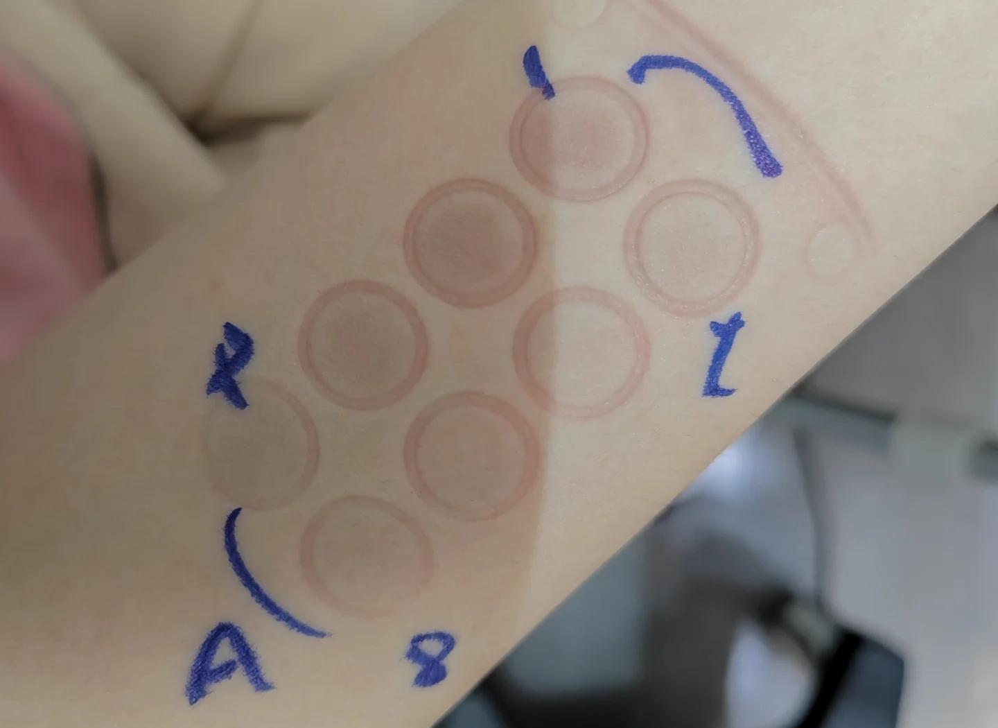 皮肤紫外线过敏的方法