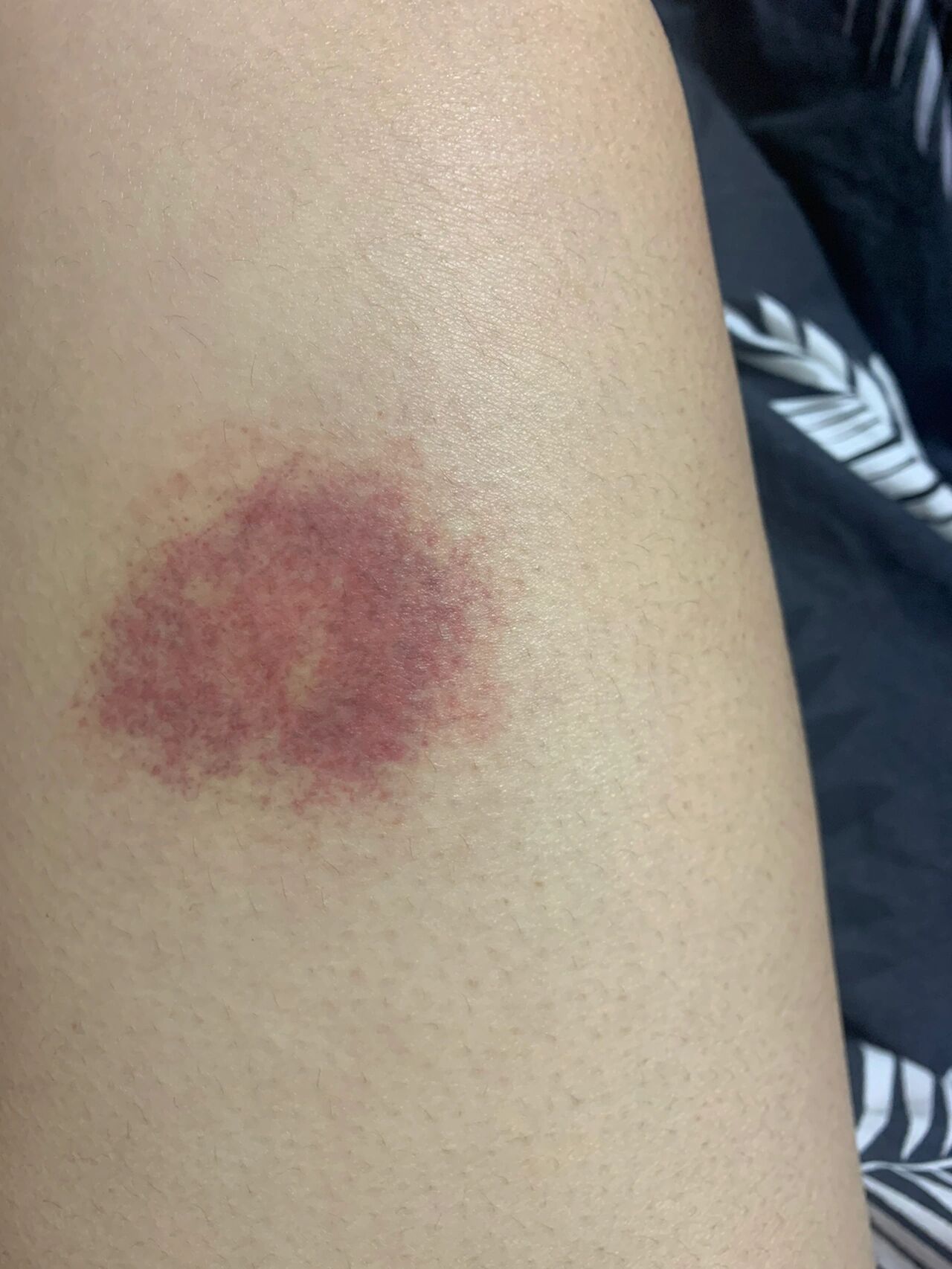 蚊子都能叮出来什么样的包