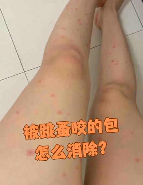 被跳蚤咬的症状图片有哪些