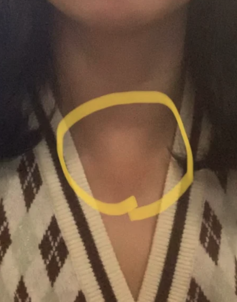 两锁骨正中间的凹窝处痣