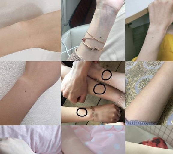 左手臂有痣代表什么预兆