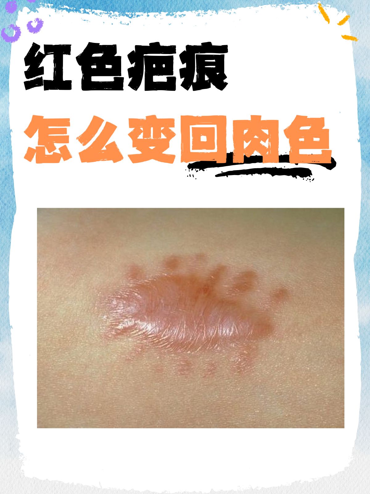 疮疤的意思疮疤是什么意思