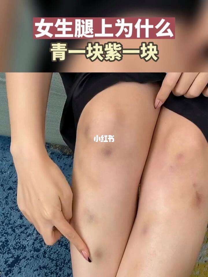 大腿上无缘无故青一块紫一块？