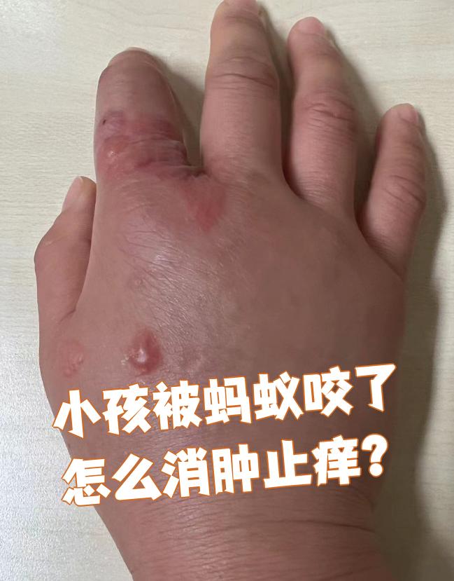 被普通的蚂蚁咬了会有事吗