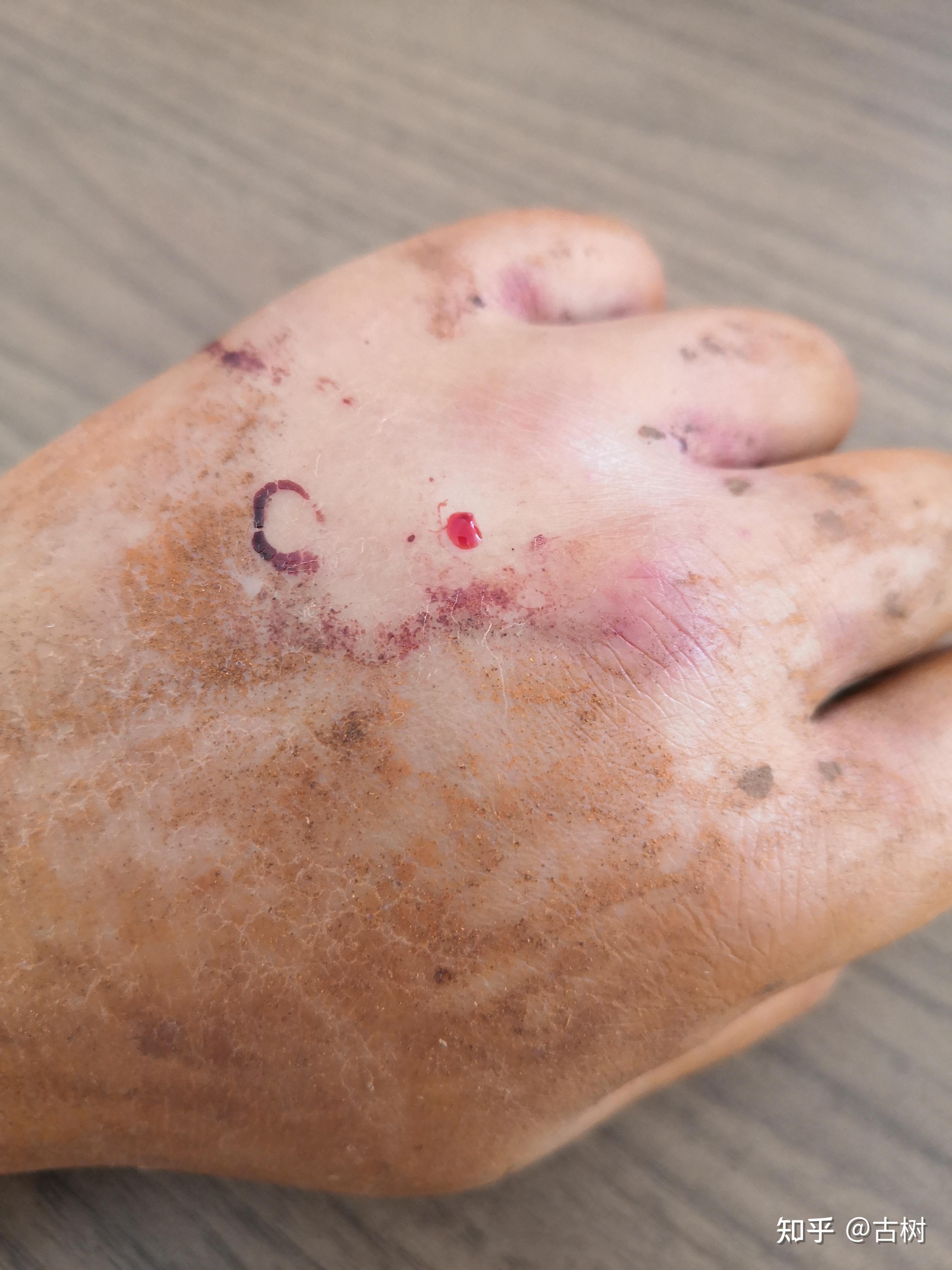 梦到被蛇咬到手没流血有什么含义