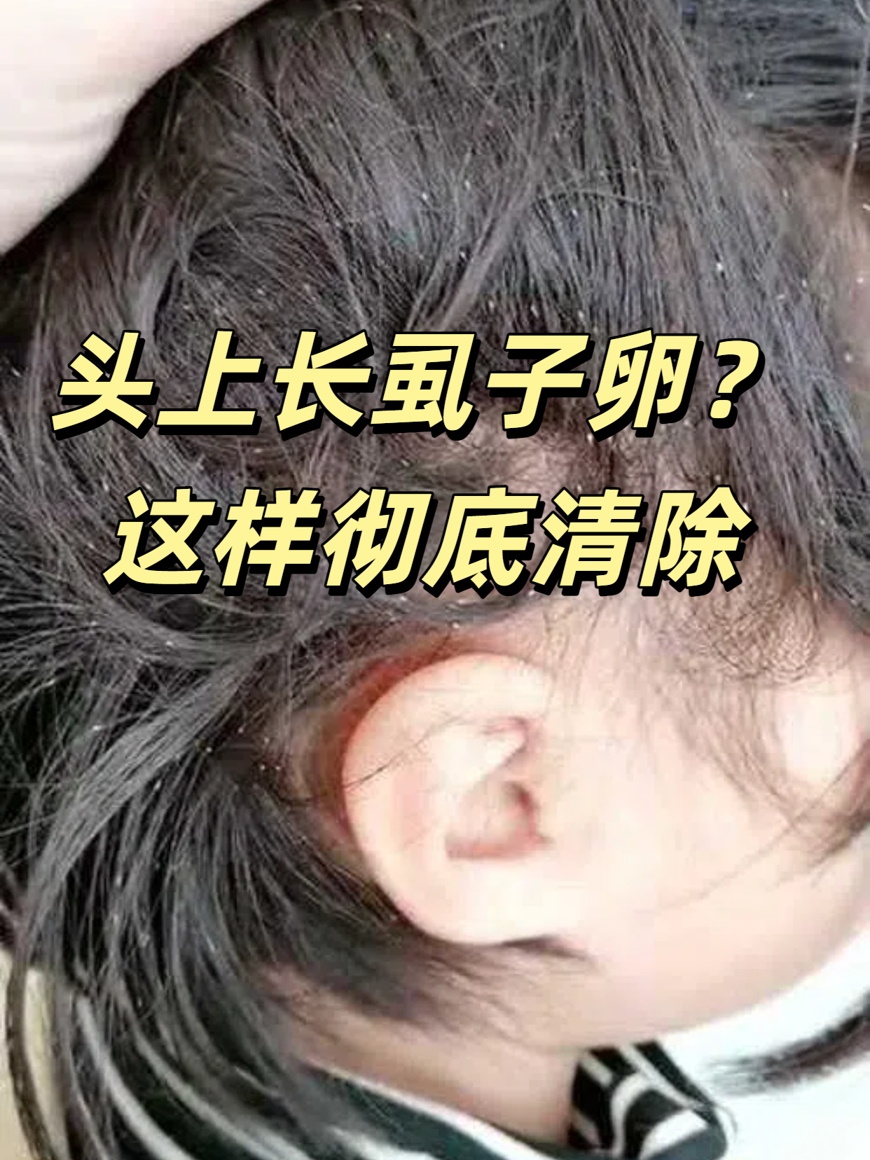 梦见头上有虱子并挤死是什么意思